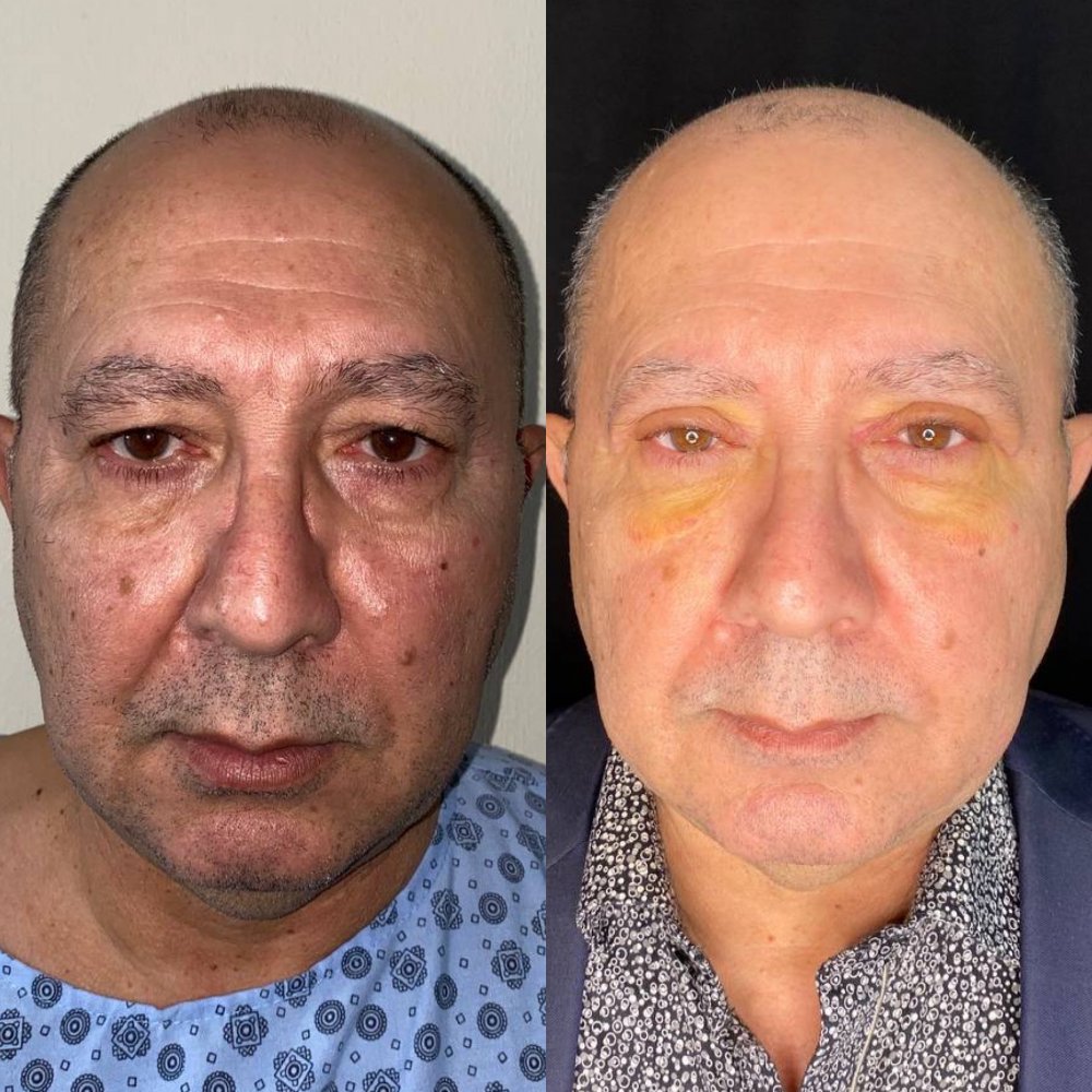 blefaroplastika əvvəl və sonra