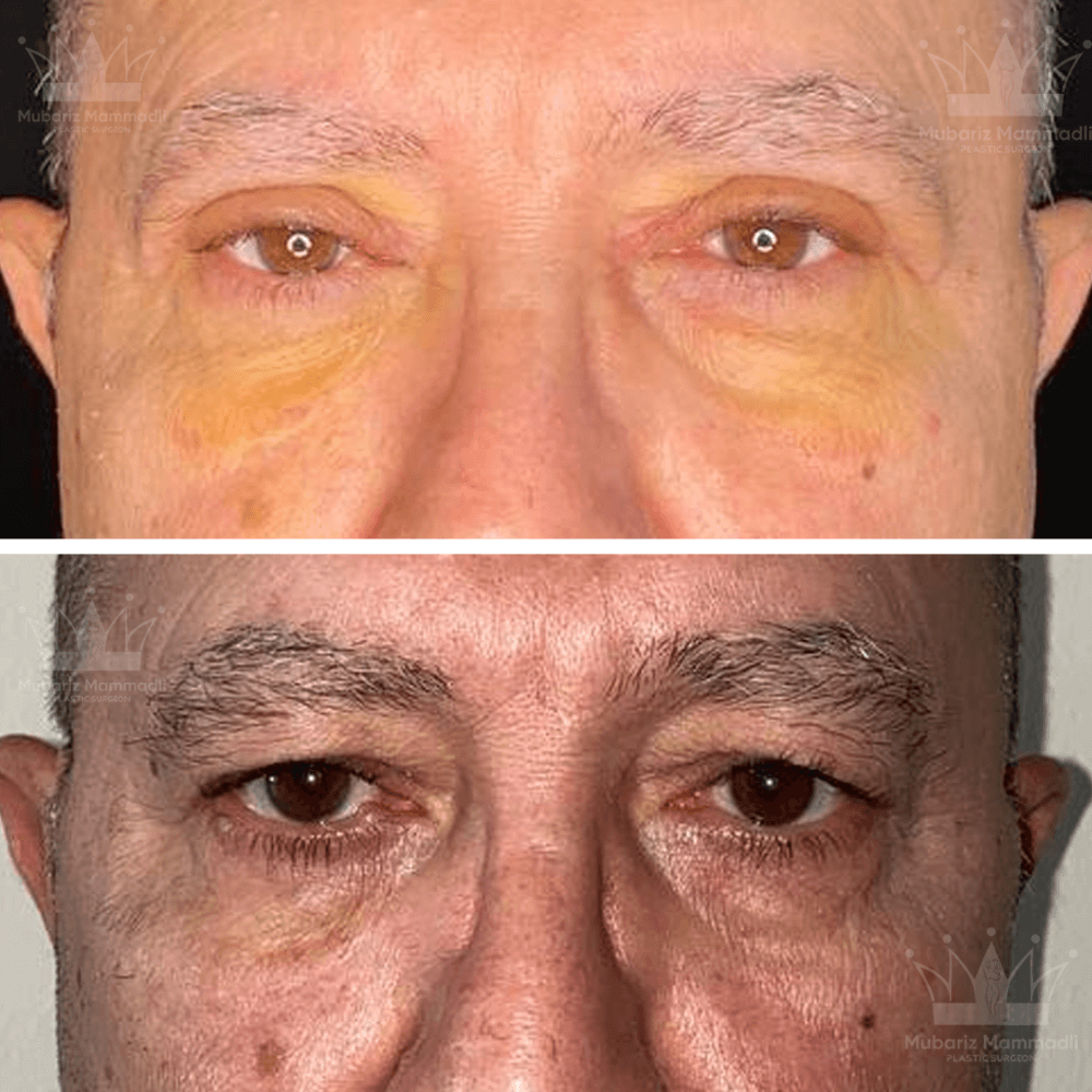 blefaroplastika