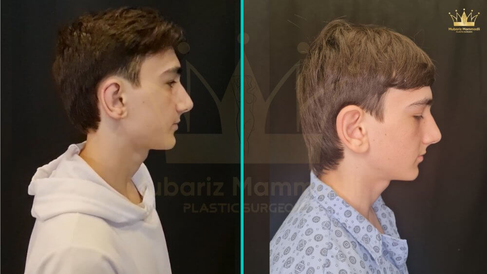 platizmoplastika