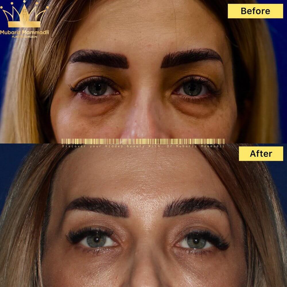alt blefaroplastika əməliyyatı
