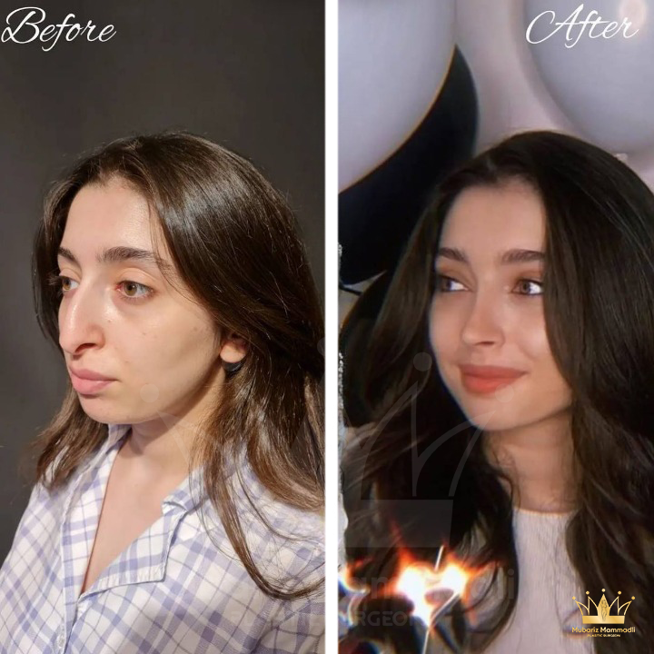 Rinoplastika əməliyyatı