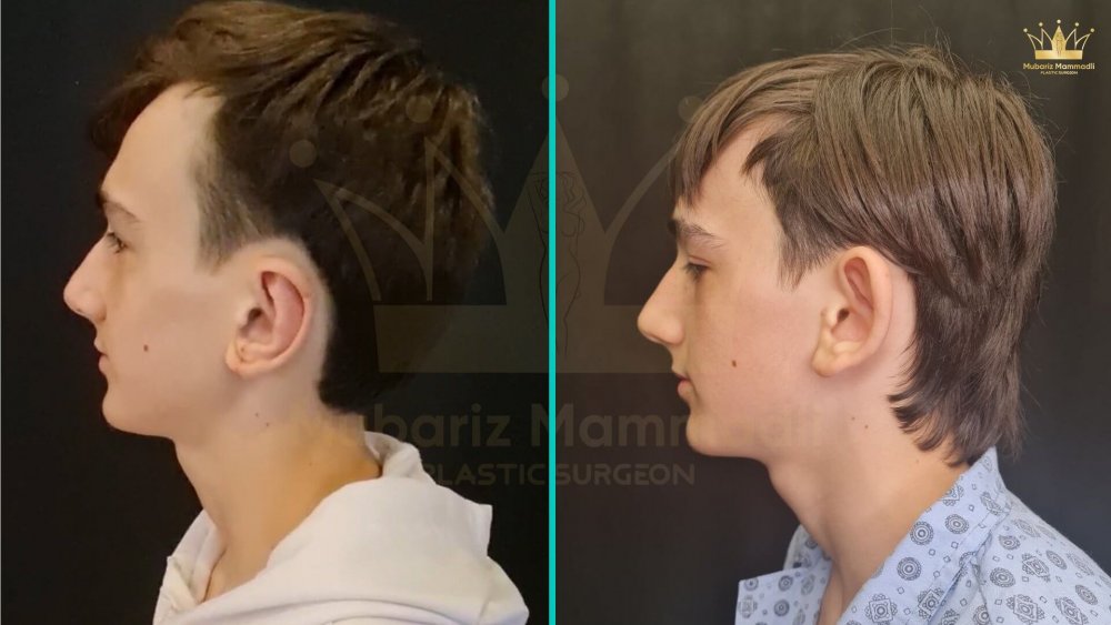 Otoplastika qulaq plastikası
