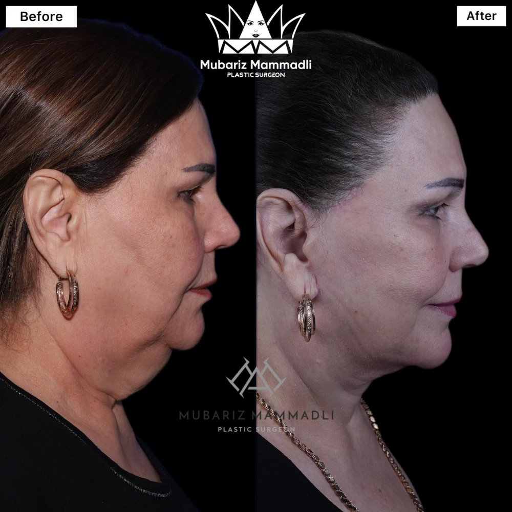 üz gərmə əməliyyatı ; uz germe emeliyyati; facelift ; facelift surgery ; plastik əməliyyat ; plastic surgery